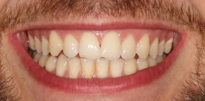 Before teeth whitening treatment at Hacton Dental Care, Hornchurch