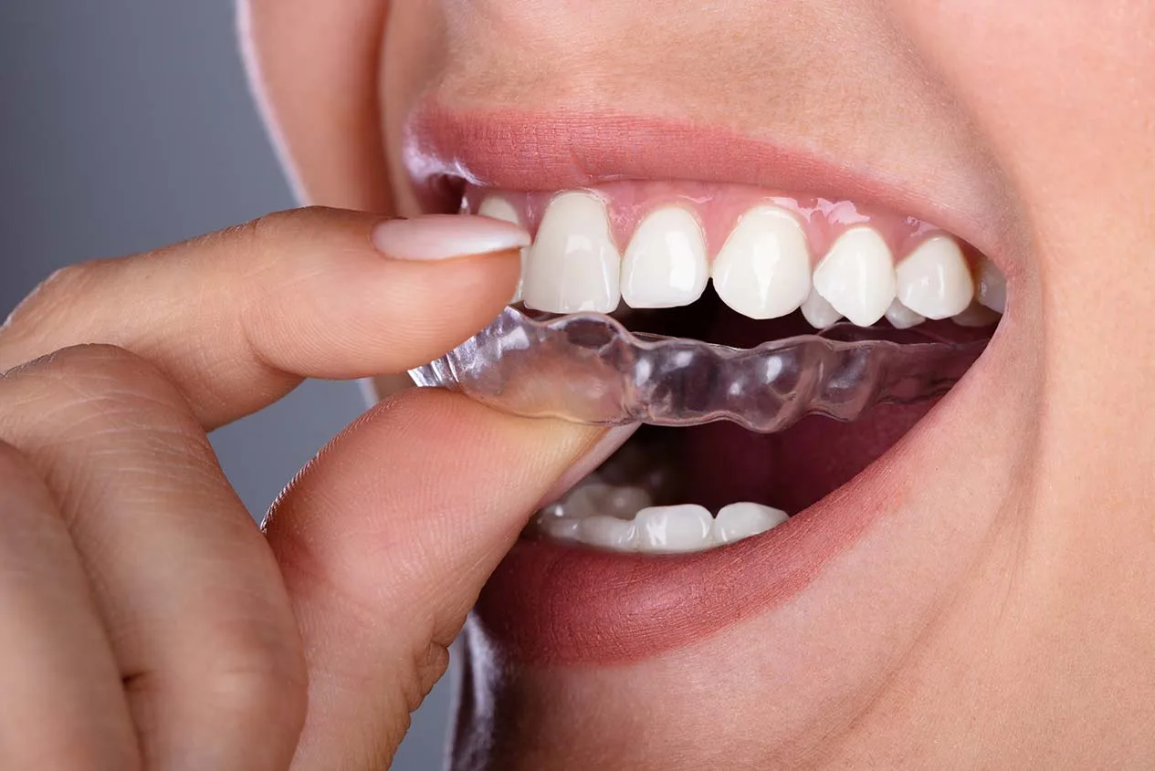 Invisalign vs clear aligners: what's the difference?